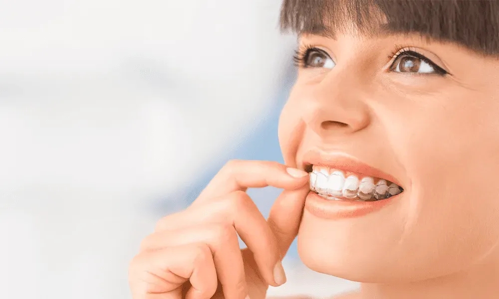 Invisalign Aligners